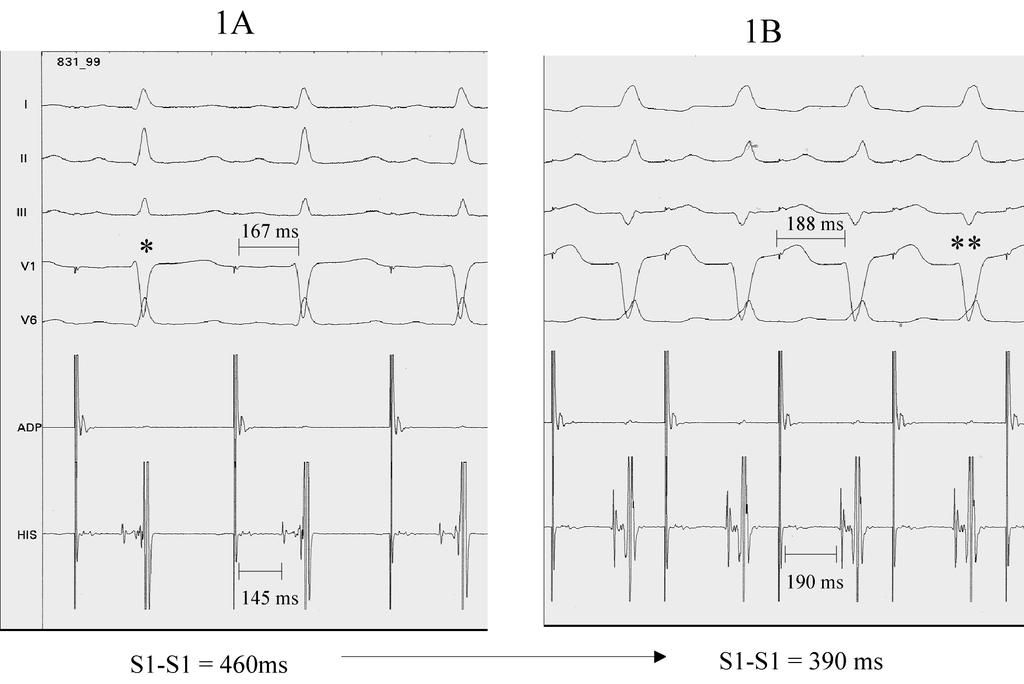 Fig. 1 - Estimulação programada em átrio direito alto, contínua, demonstrando: (1A) a um ciclo de estimulação (S1-S1) de 460ms, há discreta pré-excitação ventricular (*); (1B) na continuação do