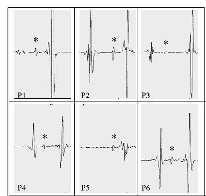 Arq Bras Cardiol A B Fig. 4 - Potencial de ativação da fibra de Mahaim (*) registros dos locais de ablação de cada paciente (P1 a P6). Fig. 3 - Taquicardia antidrômica pela fibra de Mahaim.