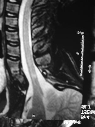 sinais de consolidação óssea, visualizados em radiografias dinâmicas ou tomografias computadorizadas da coluna cervical.