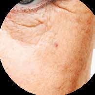 concentração de pro-colágeno na pele.