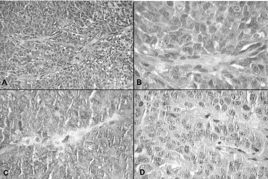 Figura 4. Neoplasia epitelial de padrão adenomatoso, sólido, formada por proliferação de células poligonais, de citoplasma amplo, basofílico (A e B).