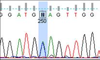 a) Padrão de migração na FIE; b) HPLC de troca iónica mostrando um pico na zona da Hb A 2