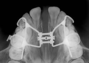 A B C D Figura 17 - Sequência de radiografias oclusais totais da maxila (Adaptado de Silva Filho, O.G et al.2008). Macedo, C.