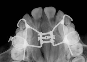 (2009) avaliaram a neoformação óssea da sutura palatina mediana por meio de análise de densidade óptica após a ERMCA.