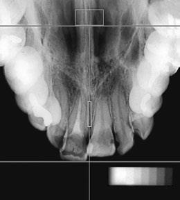 A B Figura 18 A) Radiografia oclusal antes