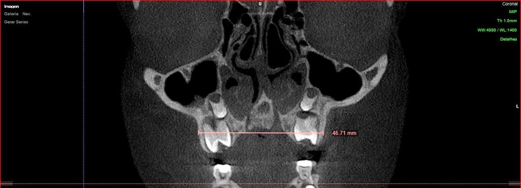 Material e Métodos 49 LM x CN 6 LM x BF 6 Figura 10 - Dimensões transversais externas da maxila medidas na reconstrução coronal 6.