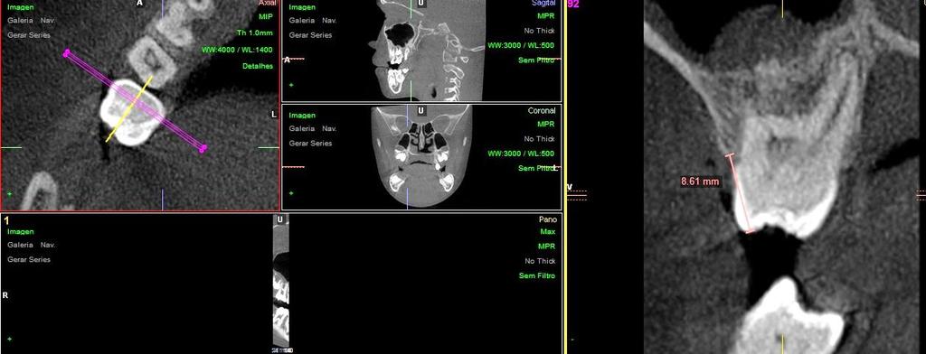 Material e Métodos 53 NCOV 16 Figura 16 - Nível da crista óssea alveolar vestibular do primeiro molar permanente do lado direito.