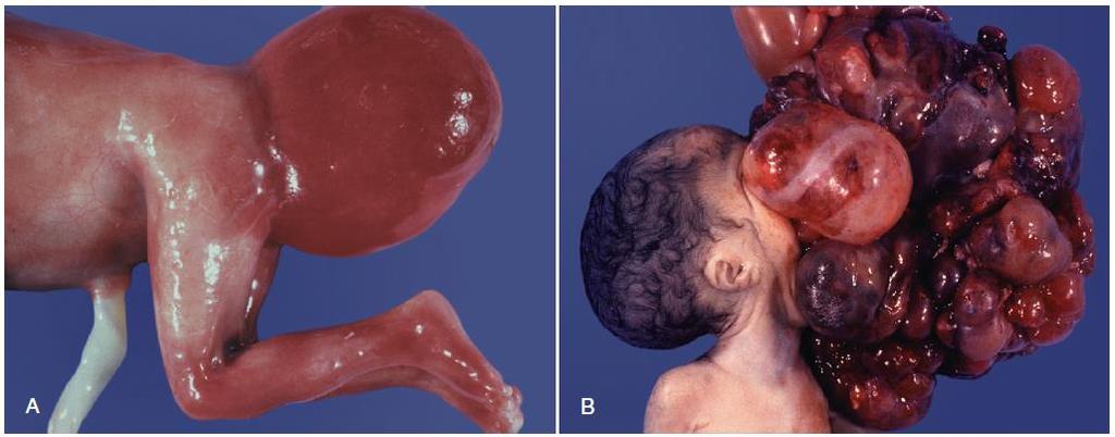 1. a fase: origem e migração das células germinativas primordiais (CGP) Uma falha na localização final correta das