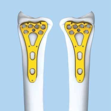 FRACTURE REDUÇÃO DA REDUCTION FRATURA REDUÇÃO REDUCE FRACTURE DA FRATURA AND E POSITION POSICIONAMENTO PLATE DA PLACA Uma das duas seguintes abordagens é então utilizada: Reduza a fratura e posicione