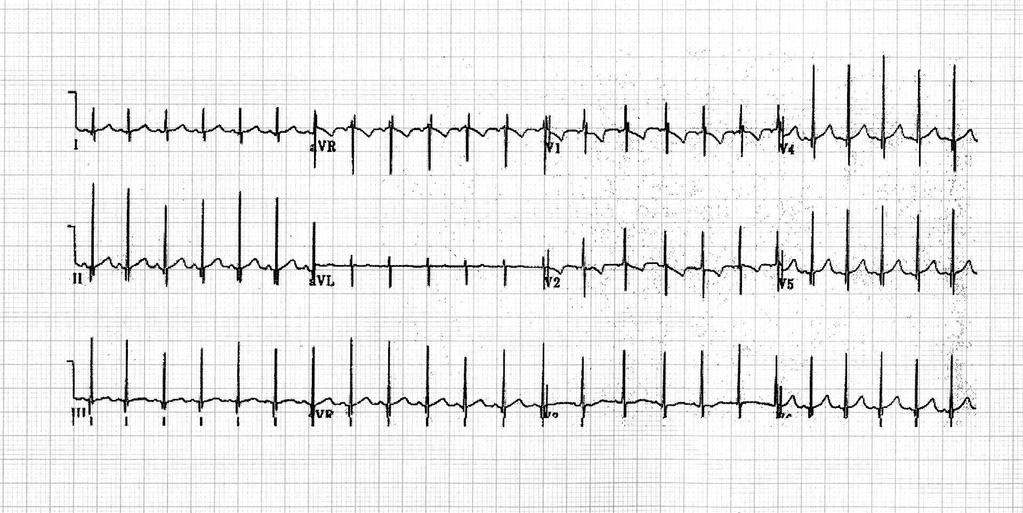 O ECG NORMAL DA