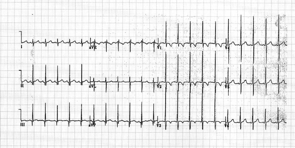 O ECG NORMAL DA