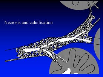 CALCIFICADO