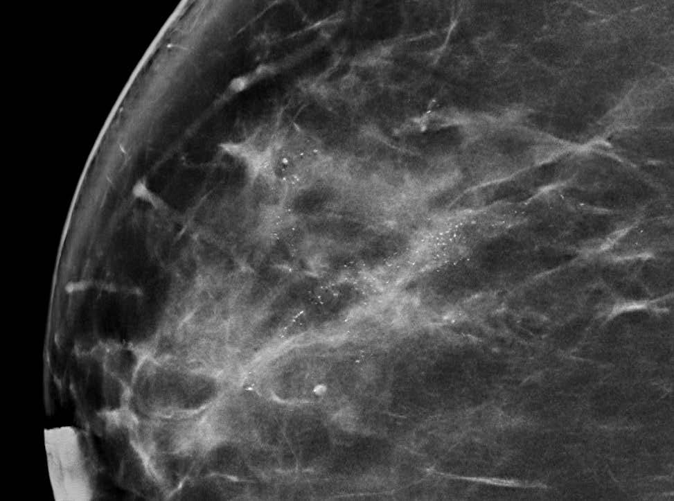 CARCINOMA DUCTAL IN SITU Mamografia digital e