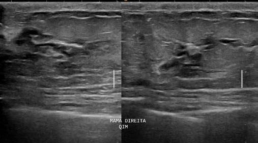 papiloma intraductal com hiperplasia usual