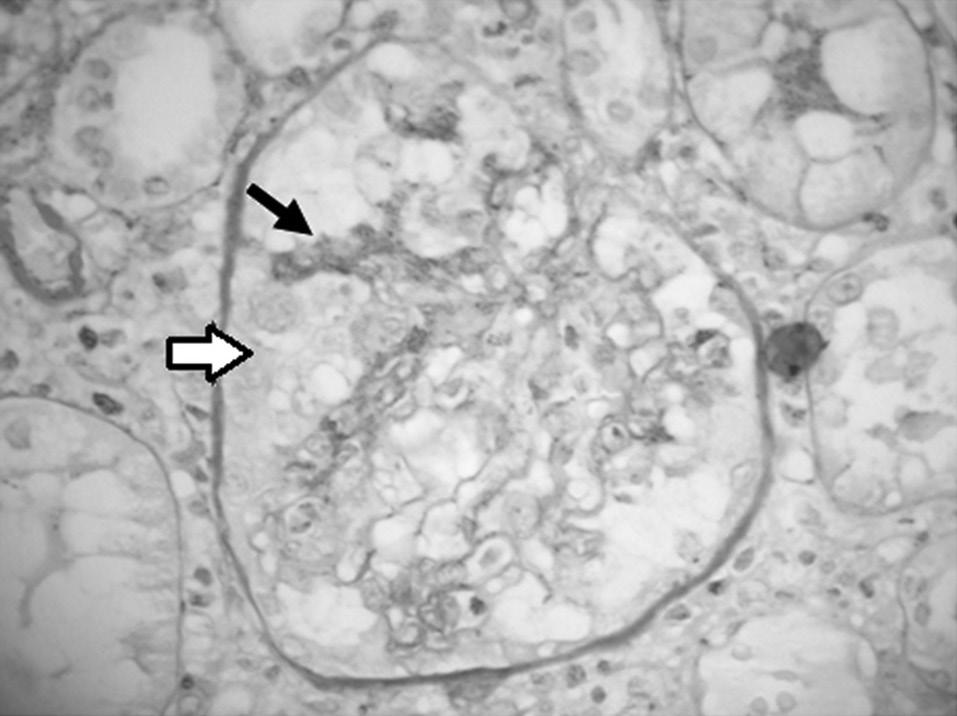 Figura 1. Microscopia óptica corada por PAS demonstrando segmento glomerular com colapso de alça circundado por proliferação de células epiteliais esboçando pseudocrescentes (HE 400x). Figura 3.