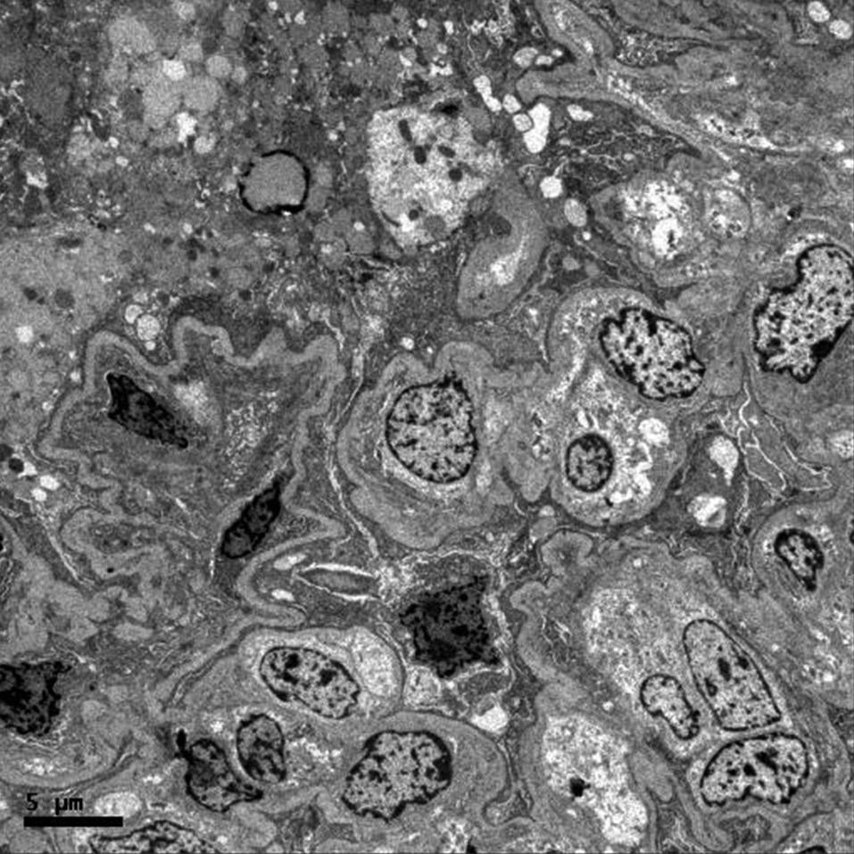 Microscopia eletrônica em baixa magnificação demonstrando capilares glomerulares colapsados e espaço extracapilar preenchido por podócitos com desabamento difuso dos pedicelos e grande vacuolização,