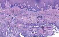 proliferação de fibroblastos, na qual observam-se formações de tecido mineralizado em vários estágios de calcificação e ainda presença de células gigantes multinucleadas, caracterizando, portanto, um