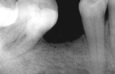 Além disso, fatores irritantes ao ligamento periodontal, como cálculo subgengival, excesso de restaurações, corpos estranhos no sulco, entre outros, podem agir estimulando a proliferação celular,