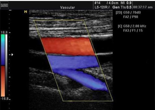 Ecodoppler venoso - Membros superiores: B54PZZZ - Membros inferiores: B54DZZZ Ecodoppler