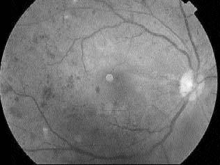 ARETINOPATIA É UMA DAS COMPLICAÇÕES mais temidas do diabetes mellitus (DM), devido à incapacidade funcional que ela provoca.