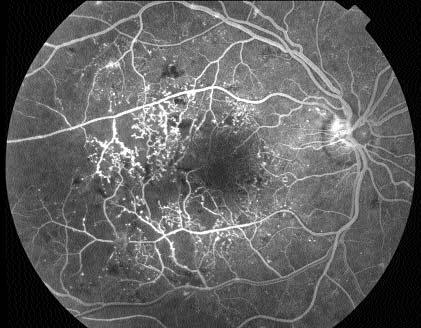 A presença de hemorragia vítrea (pré-retiniana) classifica-a como retinopatia diabética proliferativa de alto risco. Figura 3.