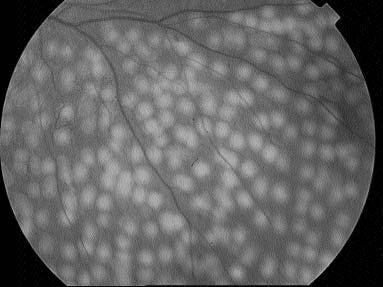 Figura 4. Panfotocoagulação retiniana com laser de argônio (marcas recentes). Nota-se que toda retina isquêmica é fotocoagulada, não apenas o local dos neovasos. Tabela 1.