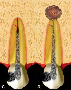 recolhidas dos canais radiculares de dentes que continham bactérias em 3 morfologias distintas conhecidas na altura: cocos, bacilos e espiroquetas (Siqueira, 2011).