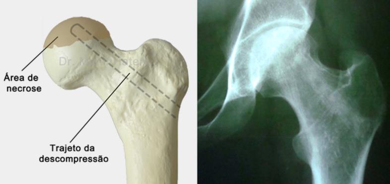 Necrose Asséptica da Cabeça