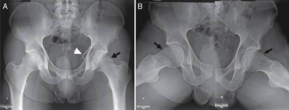 Síndrome de Impacto Fêmur Acetabular