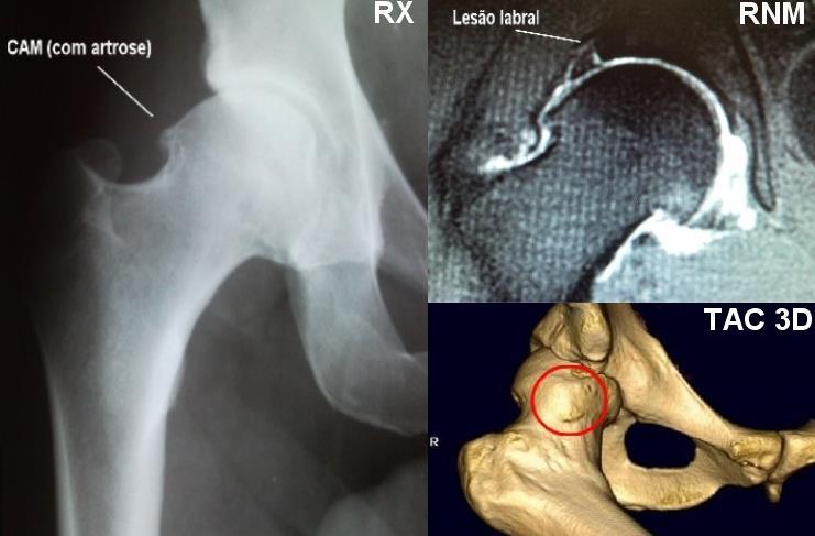 Síndrome de Impacto Fêmur Acetabular