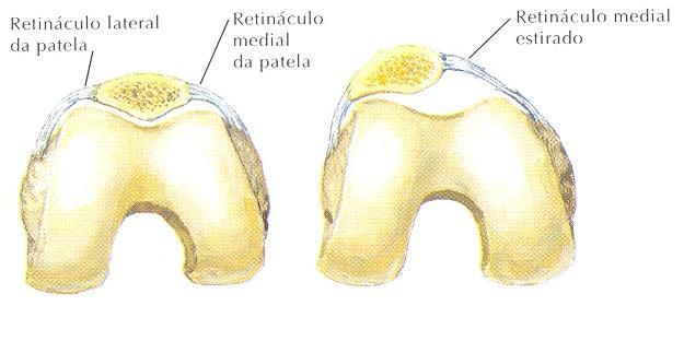 Instabilidade Patelo-Femoral