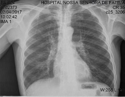 O presente estudo teve como objetivo reconhecer a transmissão viral domiciliar a partir de um relato de caso clínico.