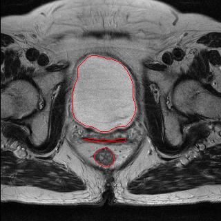 Segmentação Segmentação de órgãos da cavidade pélvica feminina a partir de imagens de