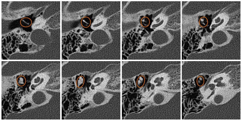 Alinhamento Aplicação na segmentação e reconstrução 3D dos ossículos do ouvido médio em imagens de TC