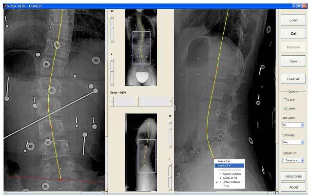 Visão 3D Reconstrução 3D da coluna a partir de duas radiografias 2D e usando um modelo deformável
