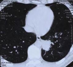 A observação da anatomia patológica incidiu sobre uma peça operatória composta de gânglio linfático com 1 cm de diâmetro, fragmento brônquico com 1,5 cm e nódulo de tecido pulmonar com 3,8x3,2 cm,