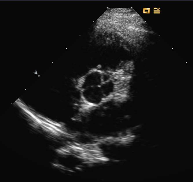 (Figura 3) Caso 4 Doente do sexo masculino, referenciado à consulta de Cardiologia Pediátrica aos 6 anos de idade, por sopro cardíaco.