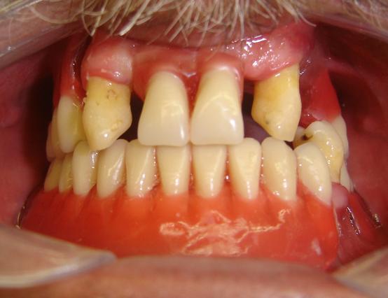 Figura 11 Prova dos dentes