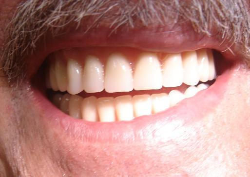 Figura 13 Dentaduras superior e inferior instaladas imediatamente após as exodontias dos elementos 13, 23, 34 e 44 - REVISÃO DE LITERATURA A população mundial está envelhecendo e, mais cedo do que se
