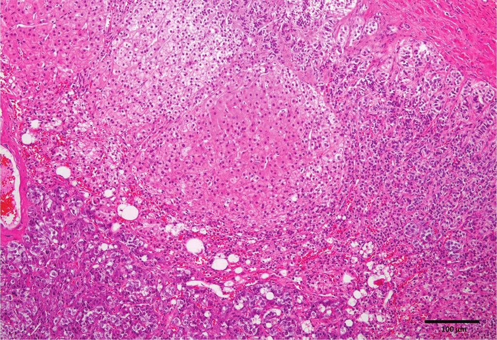 Camila Tochetto et al. Fig.. Hiperplasia nodular.