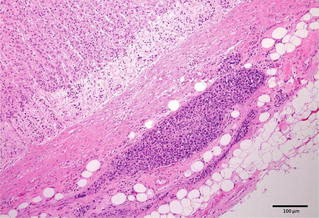 A degeneração gordurosa era caracterizada por células da zona fasciculada e da zona reticular com grandes vacúolos citoplasmáticos (próximos à região de transição entre a zona cortical e a medular)