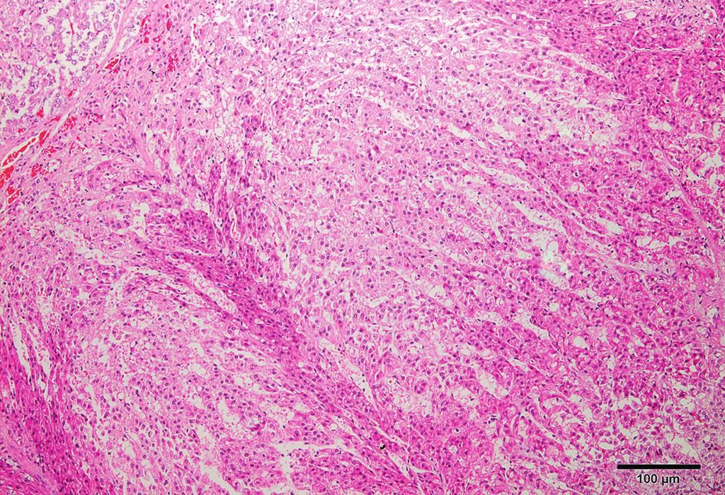 . Metástase de sarcoma histiocítico para as adrenais. Nódulos branco-amarelados, alguns com hemorragia, localizados tanto na camada cortical quanto na medular. Fig.. Adrenal de estresse.