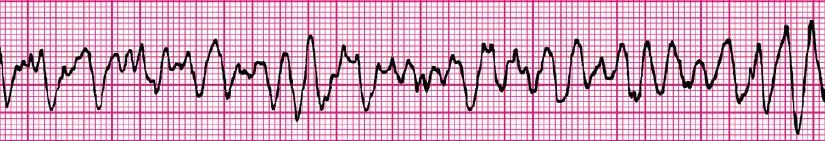 inconsistência (quando TV polimórifica); Figura 1 - Taquicardia ventricular monomórfica. Retirado de SAVT, American Heart Society, 2008.