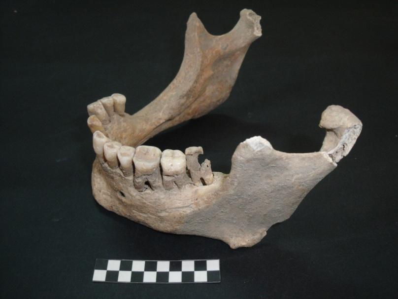 cáries apresentavam-se mais heterogéneas, encontrando-se distribuídas pelos diferentes graus 7 6 5 4 3 2 1 0 Incisivos Caninos Pré-molares Molares Pré-molares Molares Dentes superiores Dentes