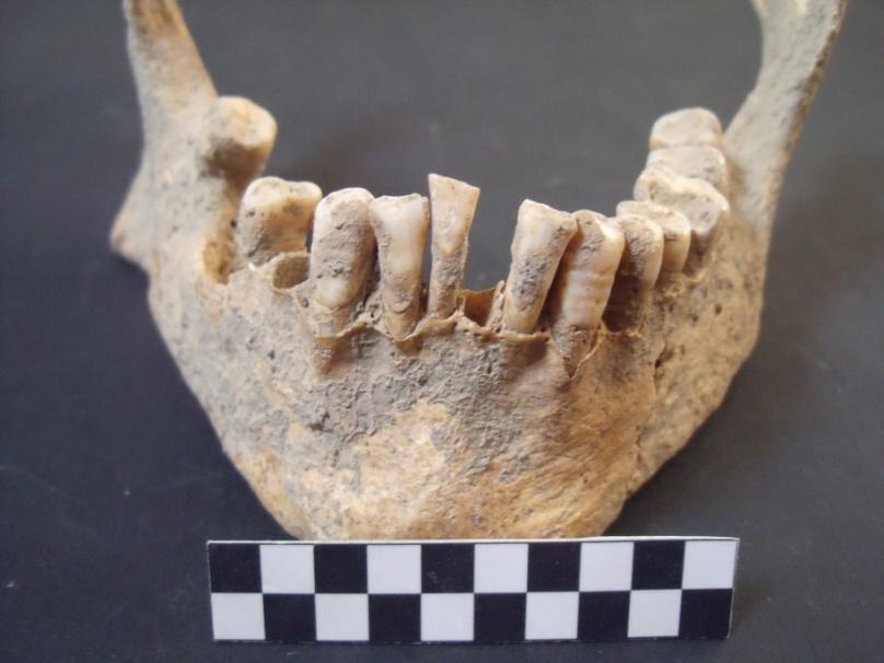 Apesar de terem sido observadas hipoplasias lineares do esmalte dentário em todos os tipos de dente, foi nos caninos que a sua presença de