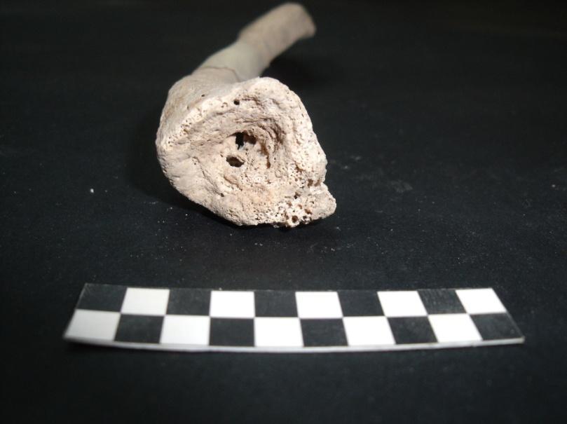 infeccioso, com formação de osso novo, apresentando ainda pequenas lesões osteolíticas (figura 32). Figura 32. Clavícula direita do indivíduo 517 com reacção infecciosa na extremidade esternal.