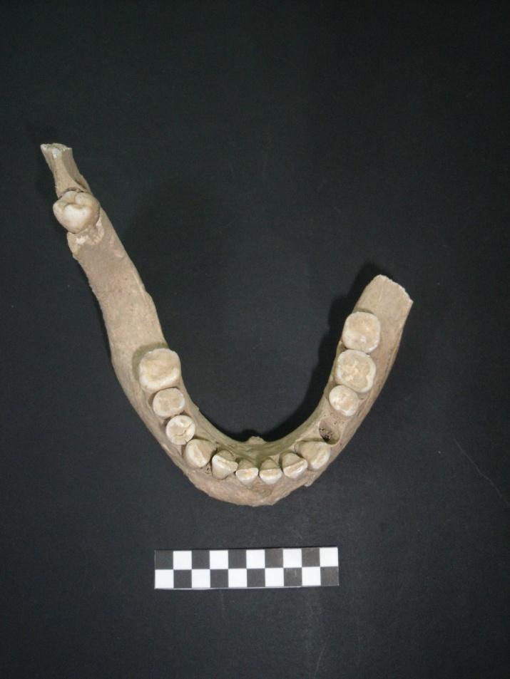 Figura 40. Erupção ectópica do 2.º molar inferior direito no côndilo mandibular (indivíduo 535). 6.