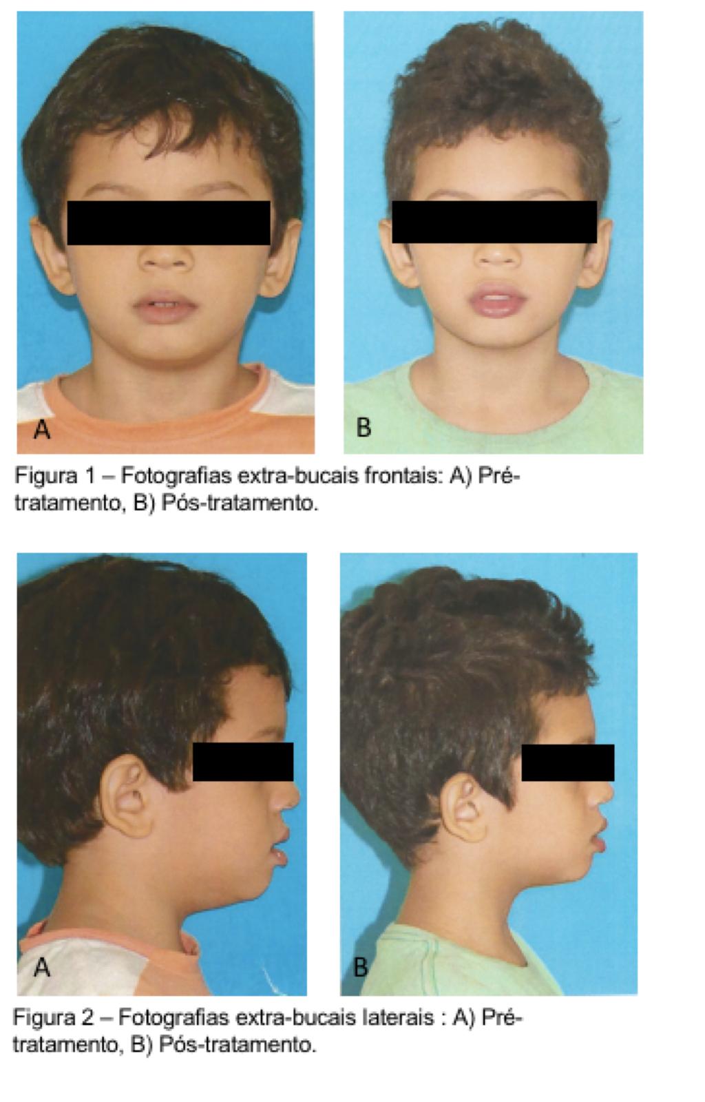 18 levou ao atraso do seu tratamento ortodôntico. Diante disso, antecipou- se a troca do Hyrax/máscara facial pelo aparelho progênico.