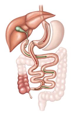 Duodenal Switch É a associação entre a gastrectomia vertical com importante desvio intestinal.