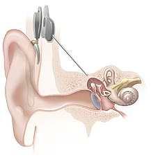 Ouvido Artificial O que é o Ouvido Artificial?